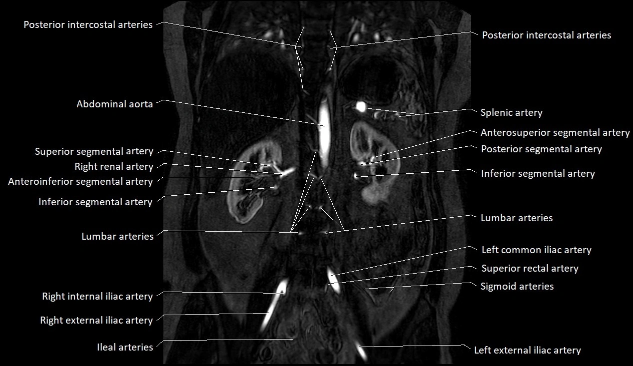 MRA Abdomen coronal anatomy image 28.webp
